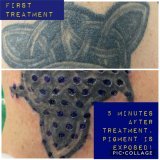 Transitions Face & Body Non-Laser Tattoo Removal