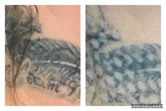 Transitions Face & Body Non-Laser Tattoo Removal