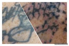 Transitions Face & Body Non-Laser Tattoo Removal